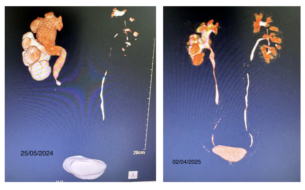 THÀNH CÔNG TRONG ĐIỀU TRỊ SỎI NIỆU QUẢN NGƯỢC DÒNG