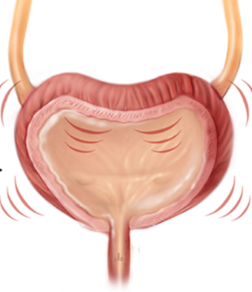 Viêm bàng quang và nhiễm trùng tiểu tái phát ở phụ nữ.