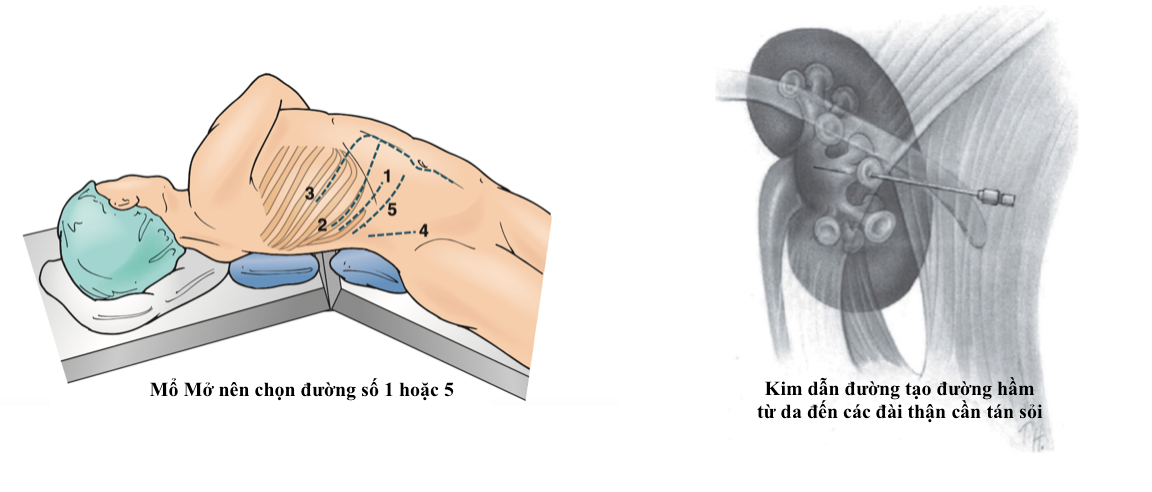 Phẩu thuật sỏi thận