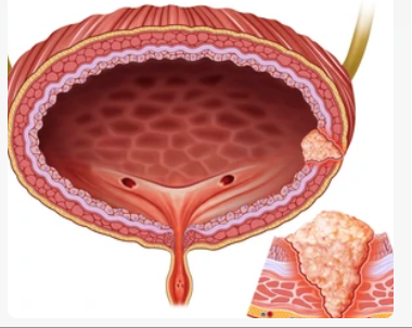 Nhiễm trùng đường tiết niệu không biến chứng tái phát ở phụ nữ cần lưu ý !