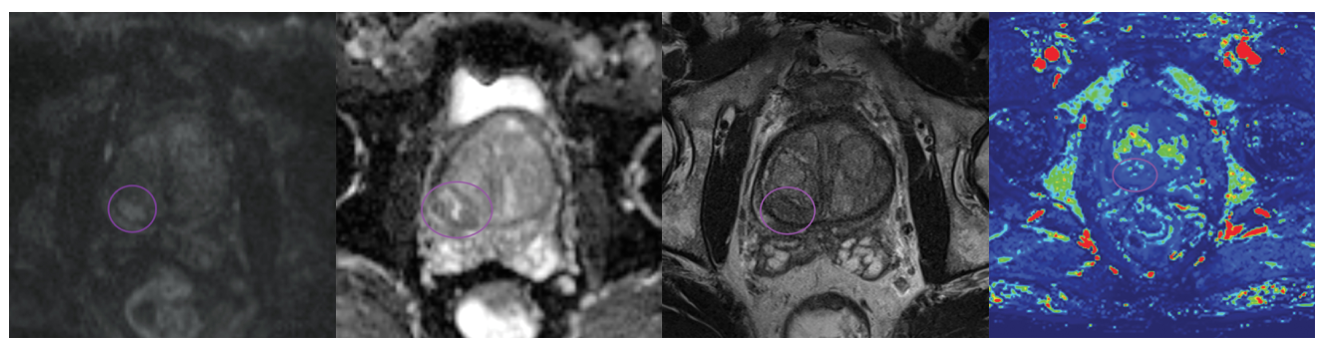 Đánh giá ung thư  TLT trên MRI bằng PI-RADS. Phiên bản mới 2.1  (2023)