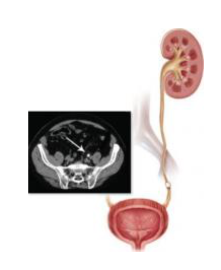 Điều trị sỏi niệu quản đau