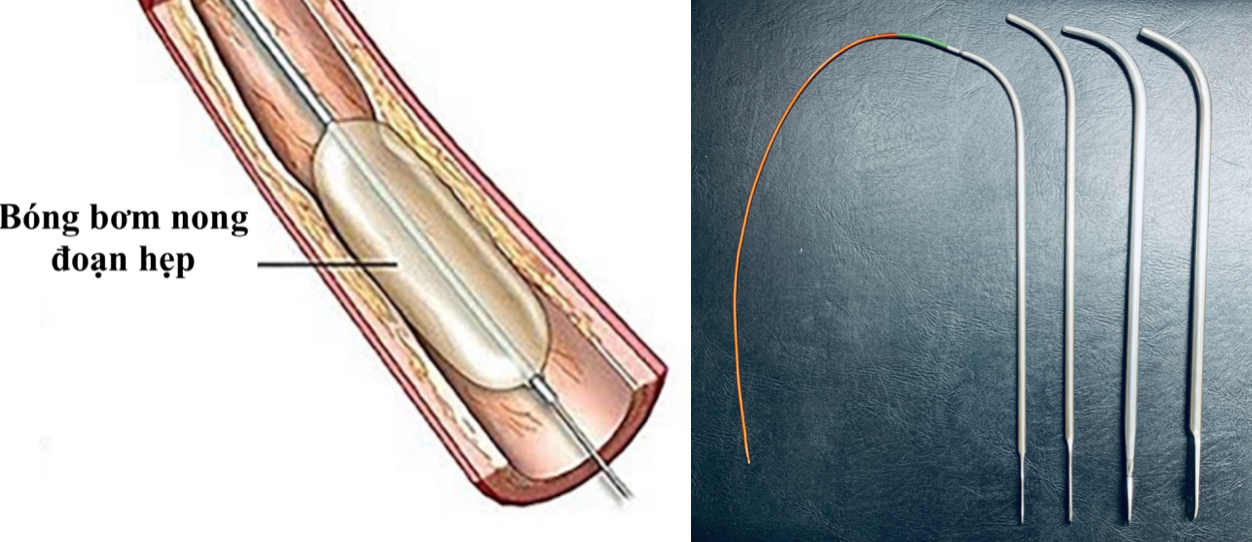Nong rộng niệu đạo