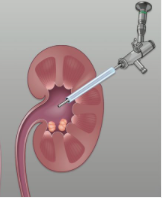 ​Biến chứng của phương pháp tán sỏi thận qua da (PCNL)
