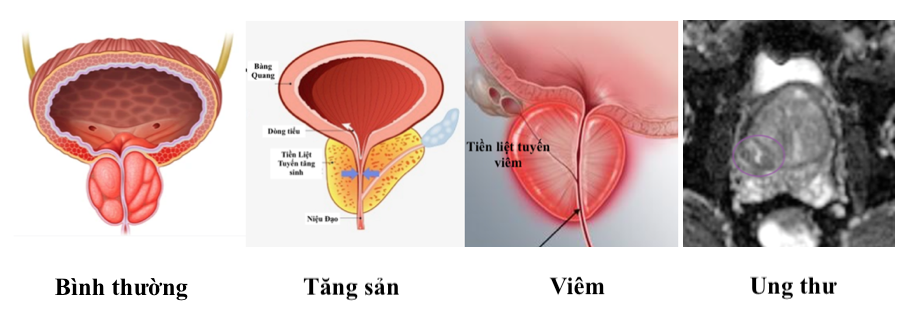 Ung thư tuyến tiền liệt, nguyên nhân khác làm tăng PSA