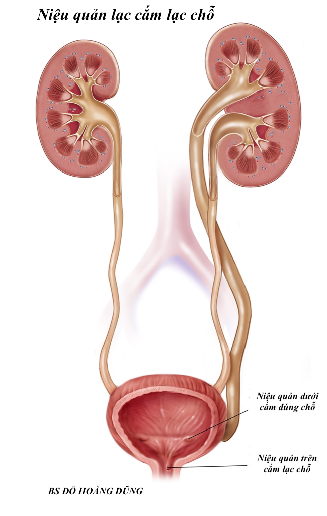 Niệu Quản Lạc Chỗ
